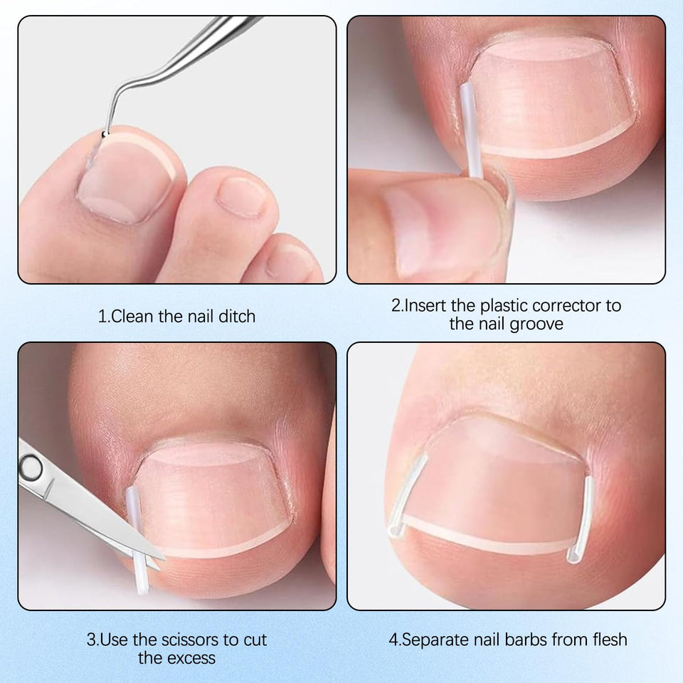 Toenail Correction Strips
