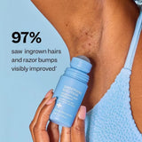 Ingrown Hair Treatment