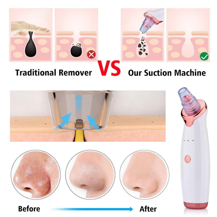 PORE VACUUM BLACKHEAD REMOVER