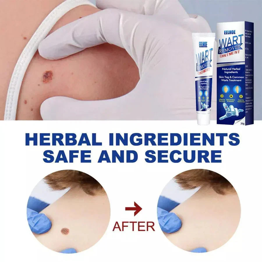 WartAway Herbal Cream